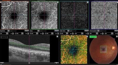 OCT Angiography