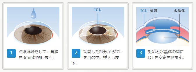 ICL手術の流れ